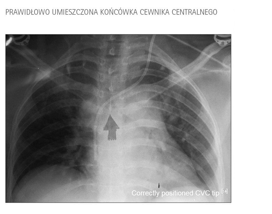 niewłaściwe umiejscowienie cewnika pod kontrolą rentgenowską