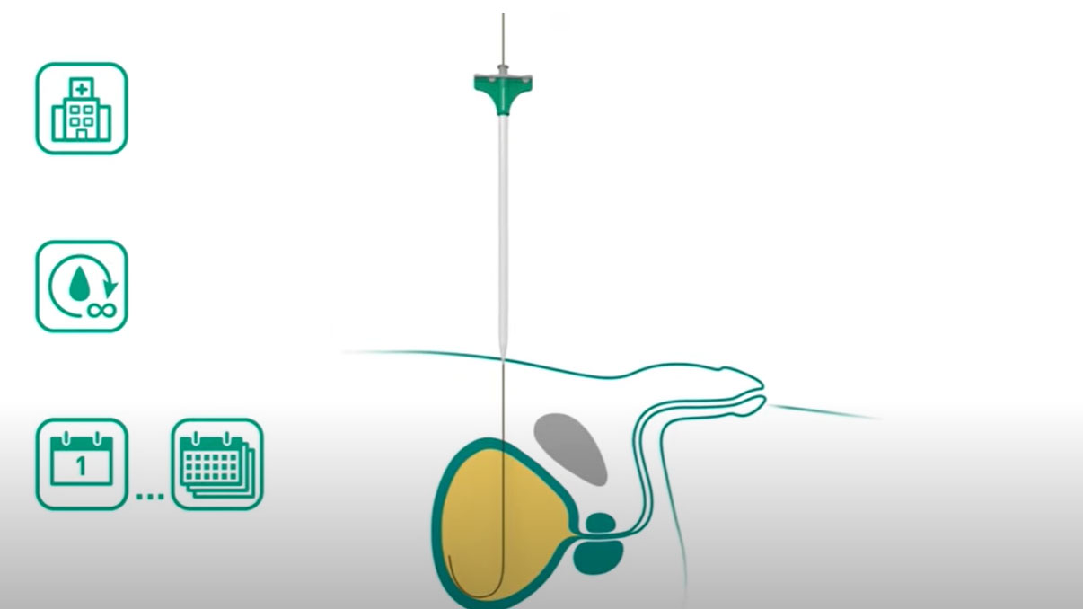 suprapubic catheterization