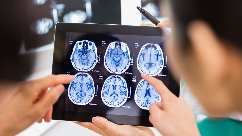 Lekarze patrzą na obraz MRI mózgu